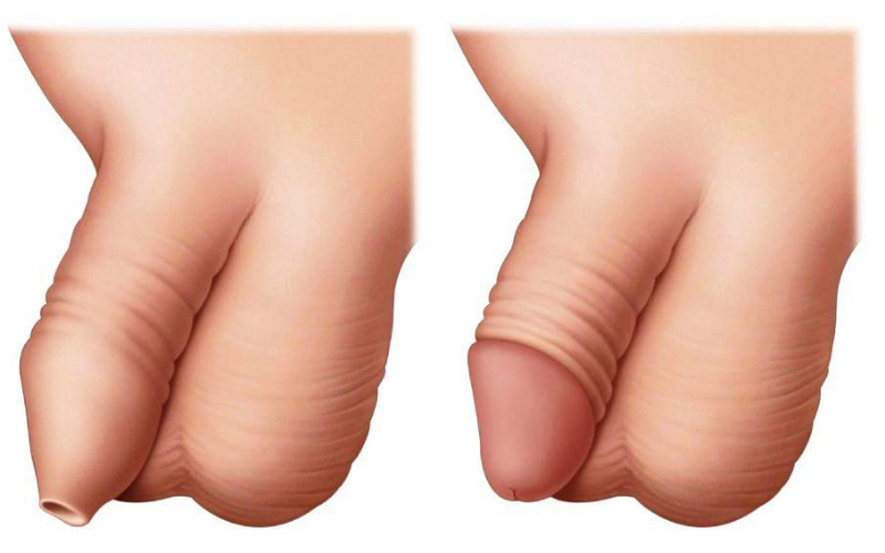 φίμωση-περιτομή