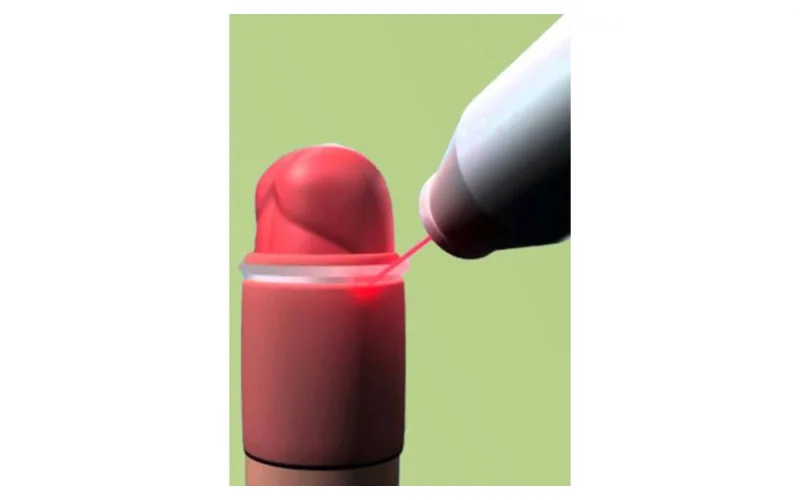 φίμωση-περιτομή