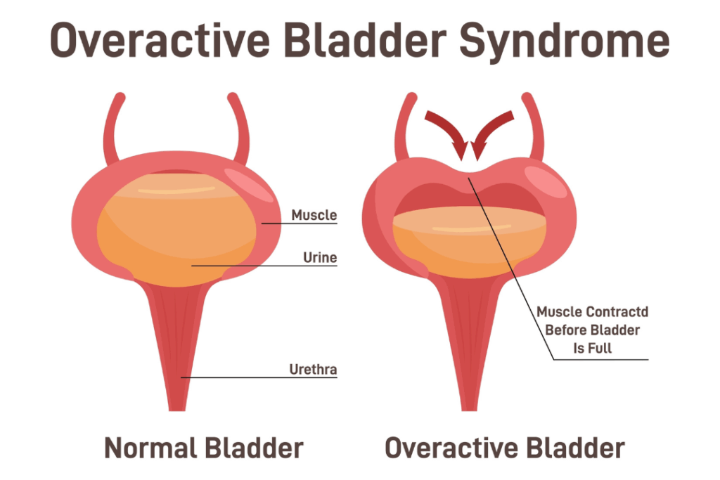 Υπερλειτουργική κύστη
